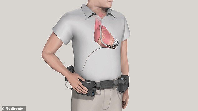 Los hospitales sabían que las máquinas cardíacas podrían provocar la muerte de más británicos, pero continuaron usándolas durante años.