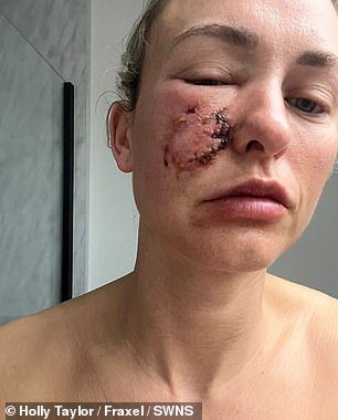 La dueña de un perro que temía que le quedarían cicatrices de por vida después de que su mascota le atacara la cara puede volver a mirarse en el espejo después de un tratamiento innovador