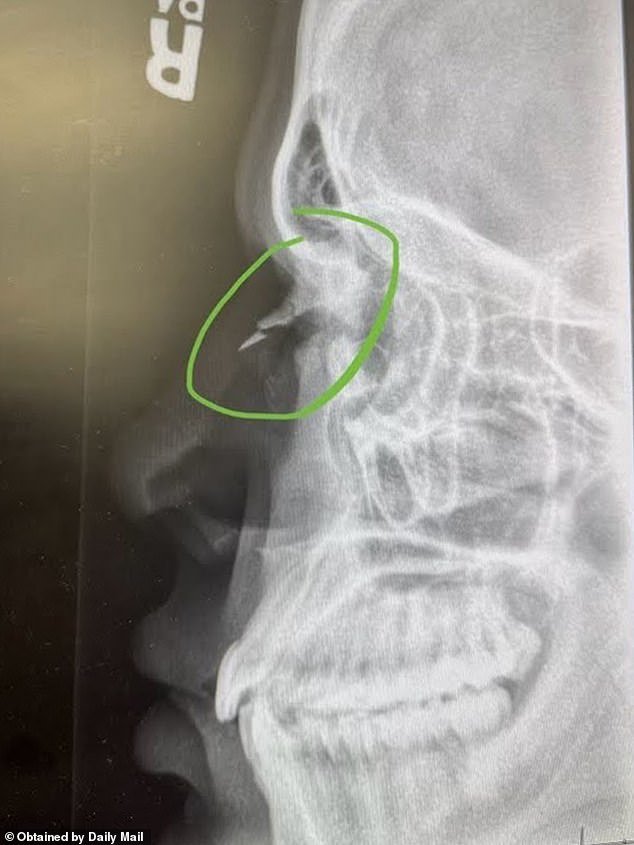 Horrible radiografía muestra las lesiones infligidas a un trabajador del gimnasio después de que Planet Fitness ‘Karen’ le propinara un puñetazo en la cara
