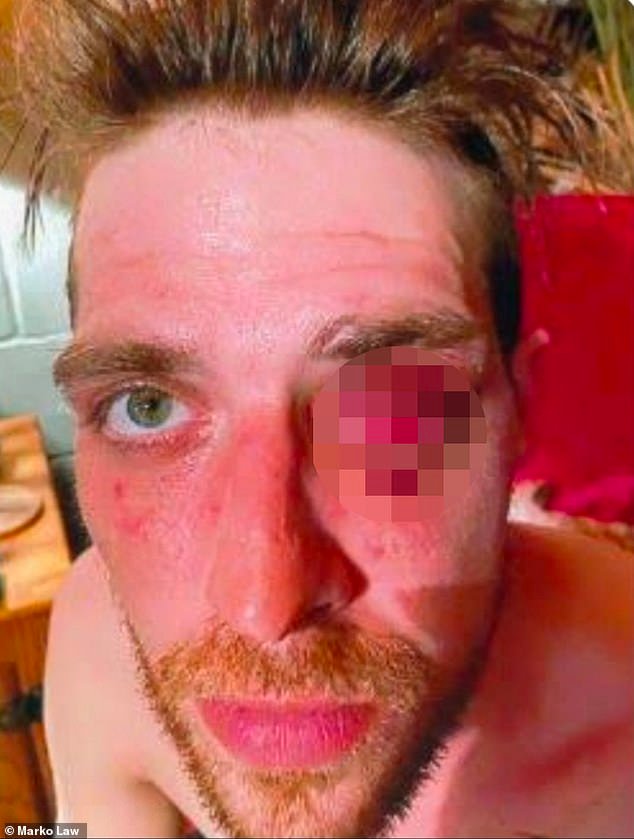 Un trabajador de la construcción que perdió un ojo después de recibir un puñetazo de un oficial de policía que gritó: “Guau, cariño, te voy a disparar con una pistola eléctrica” recibirá un pago de 4 millones de dólares.