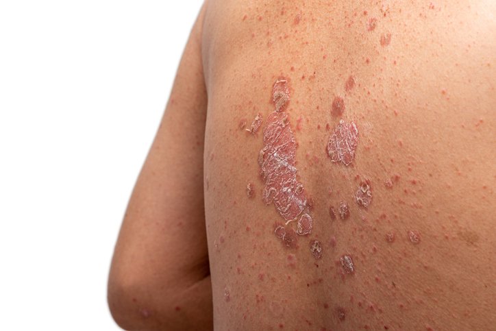 El fármaco Takeda procedente de un acuerdo de 4.000 millones de dólares tiene éxito en dos ensayos fundamentales de psoriasis en placas