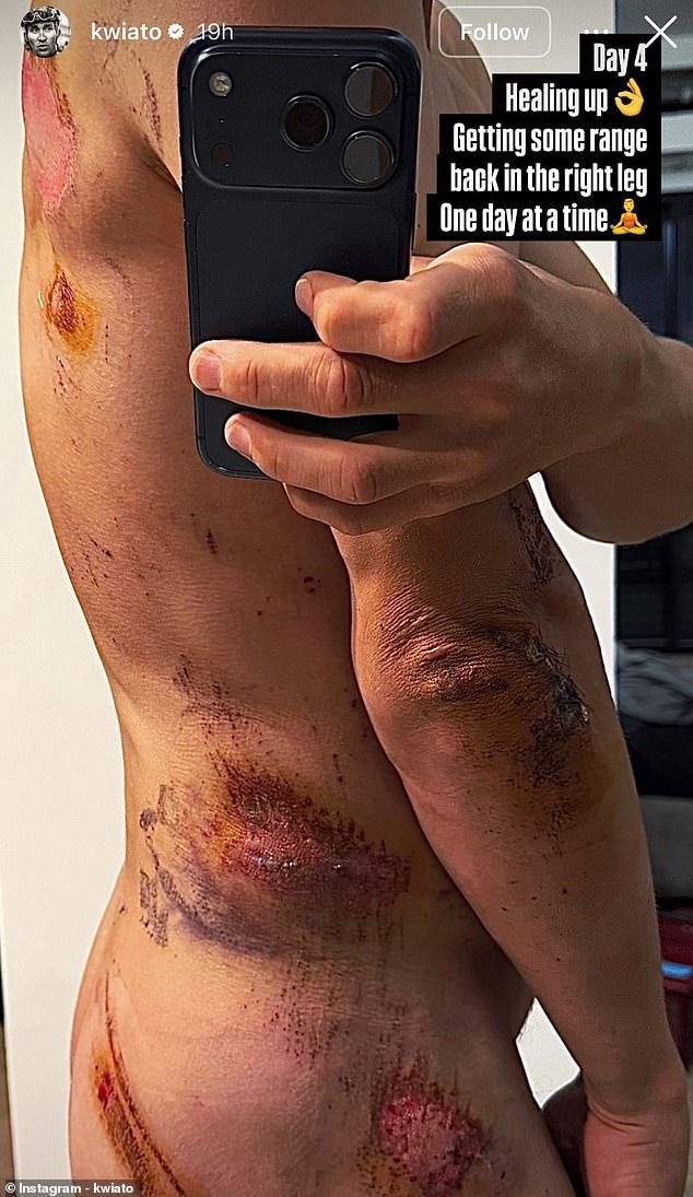 Ciclista campeón publica foto desnudo para mostrar las cicatrices del brutal accidente en el que chocó con un poste indicador y su rival