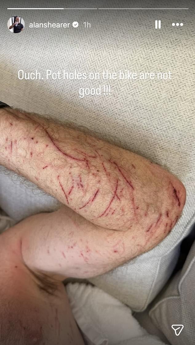 La leyenda inglesa Alan Shearer comparte horribles imágenes de cortes en su brazo y pierna después de caerse de su bicicleta