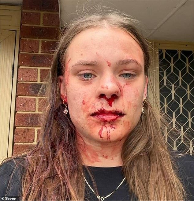 Las horribles heridas de una adolescente la dejaron maltratada después de que fue atacada por ladrones y salió de la casa temiendo ‘morir’