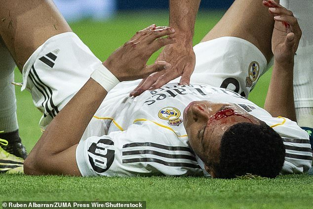 El Real Madrid está furioso porque Kylian Mbappé queda cubierto de sangre después de un puñetazo en su difícil empate contra el Girona, pero NO habrá penalización ya que Álvaro Arbeloa continúa luchando.
