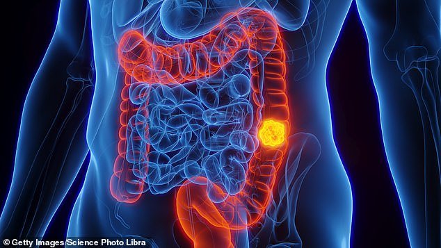 Estudios de seguimiento innovadores sobre el cáncer de colon no muestran recurrencias